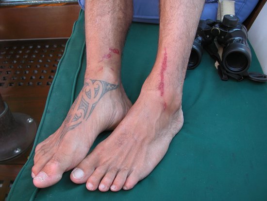 m_Rope burn from spinnaker halyard.jpg m_Rope burn from spinnaker halyard.jpg