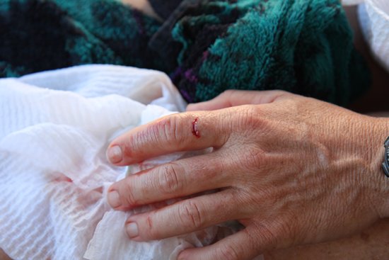 m_Finger caught between outboard and dinghy transom.jpg m_Finger caught between outboard and dinghy transom.jpg